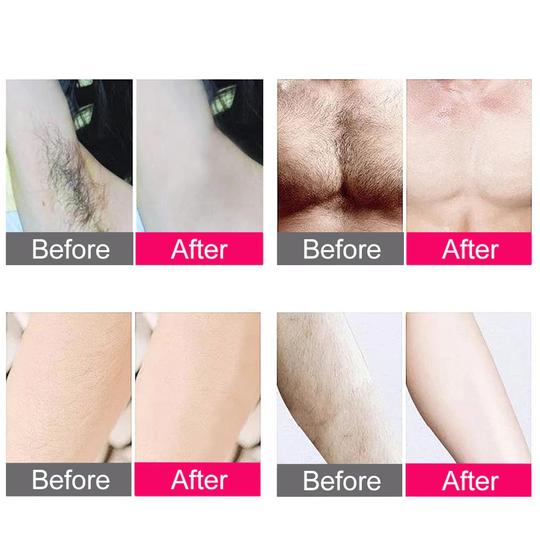 IPL LASER HAIR REMOVAL HANDSET AT HOME