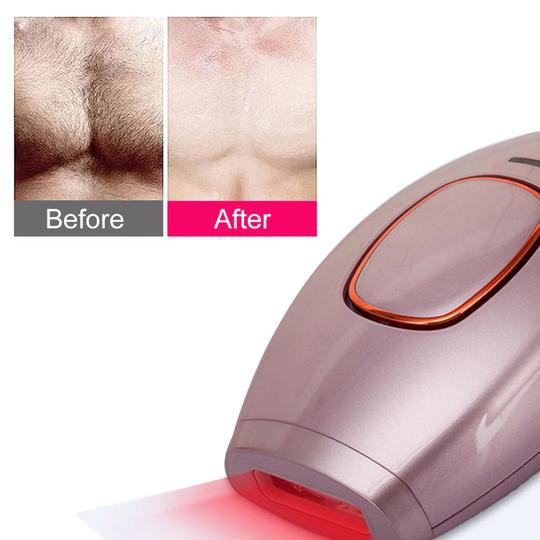 IPL LASER HAIR REMOVAL HANDSET AT HOME